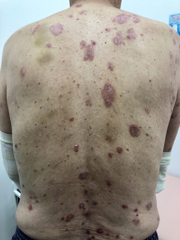乾癬 アトピー性皮膚炎の治療 梅島駅のみずき皮膚科クリニック